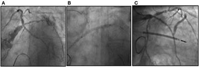 Percutaneous Trans-septal Mitral Valve-in-Ring Implantation Using a Transcatheter Balloon-Expandable Transcatheter Heart Valve With Elective Intra-Procedural Artero-Venous ECMO in a Patient With Severely Reduced Left Ventricular Ejection Fraction